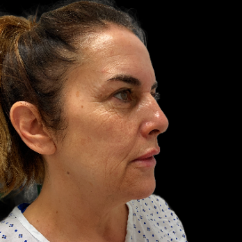 deepplane-facelift-before